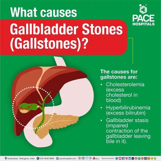 can chewing tobacco cause gallstones Gallstones, Gallbladder Stones – Symptoms, Causes, Complications Drinks Causing Gallstones: The Shocking