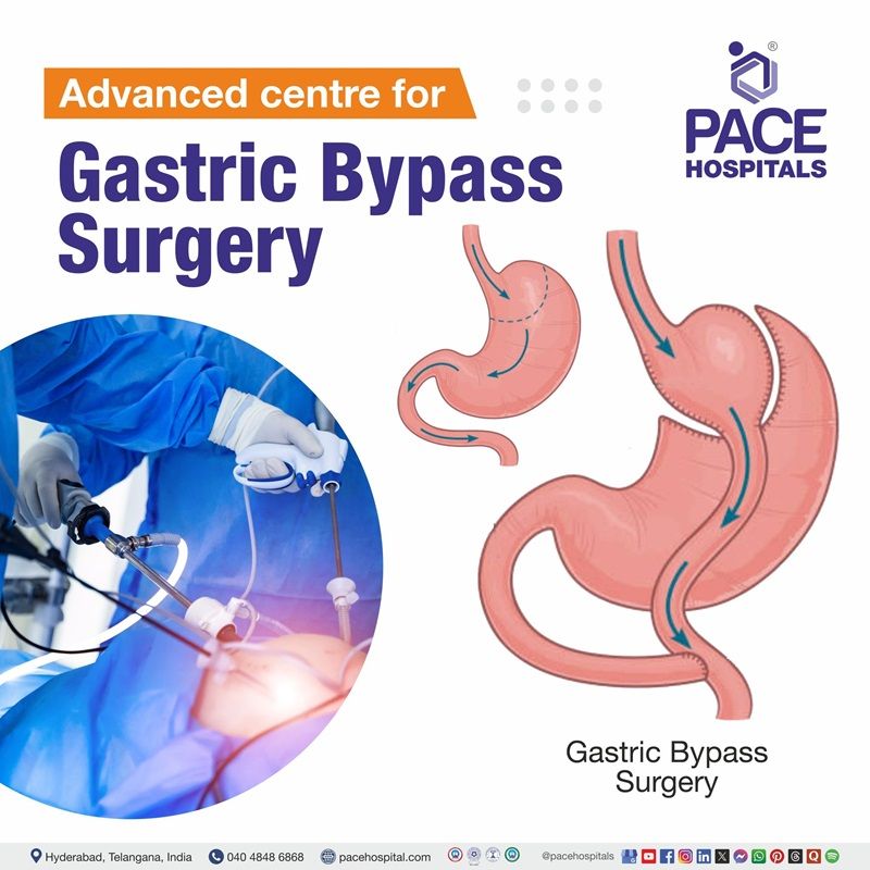 Best Hospital for Gastric Bypass surgery in Hyderabad | Roux en y gastric bypass Surgery in Hyderabad, India
