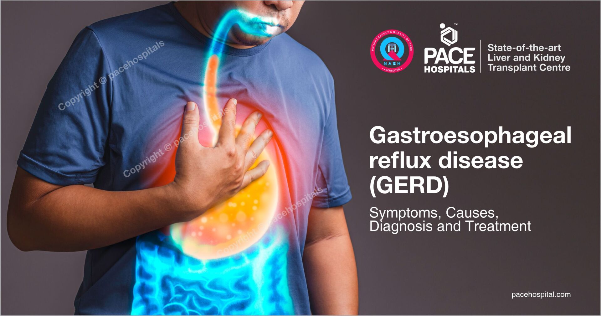GERD (Gastroesophageal reflux disease) - Symptoms, Causes, Diagnosis and Treatment