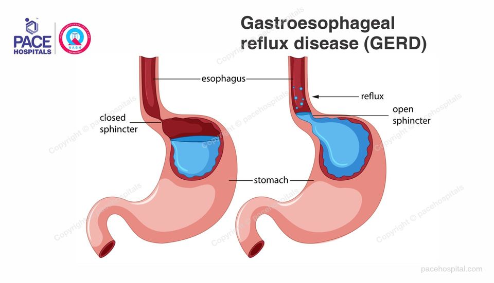 Gastroesophageal Reflux Disease GERD Symptoms Causes Diagnosis 