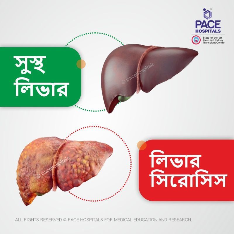 healthy liver and liver cirrhosis in bengali