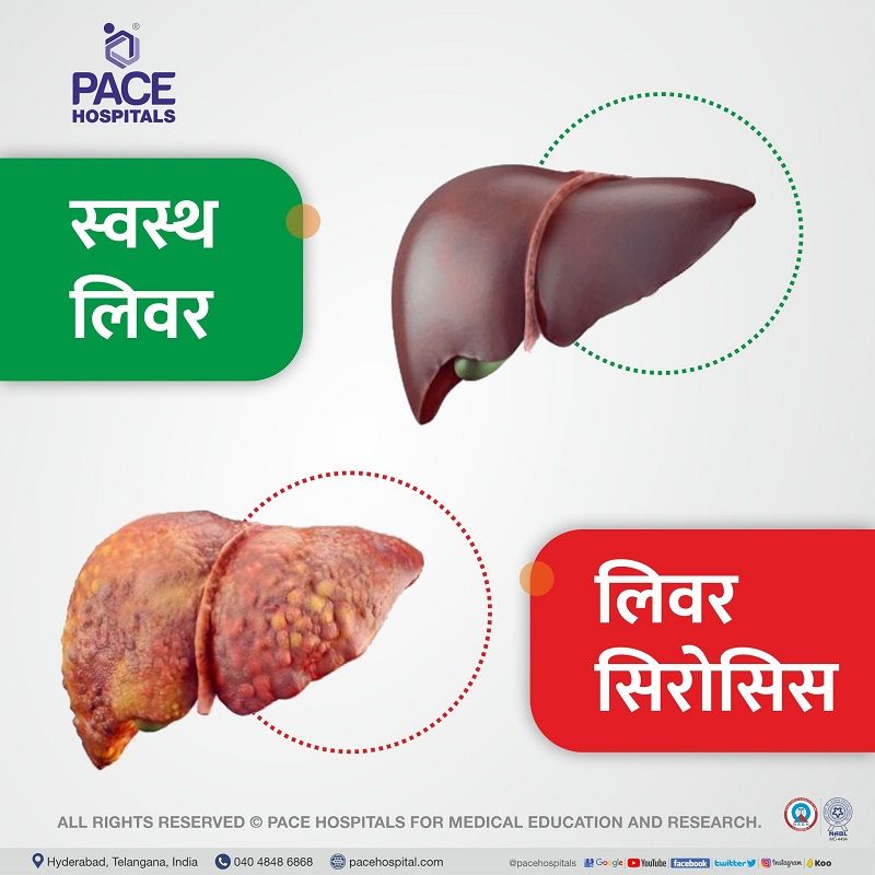 Indications for liver transplant in hindi | healthy liver and liver cirrhosis in hindi