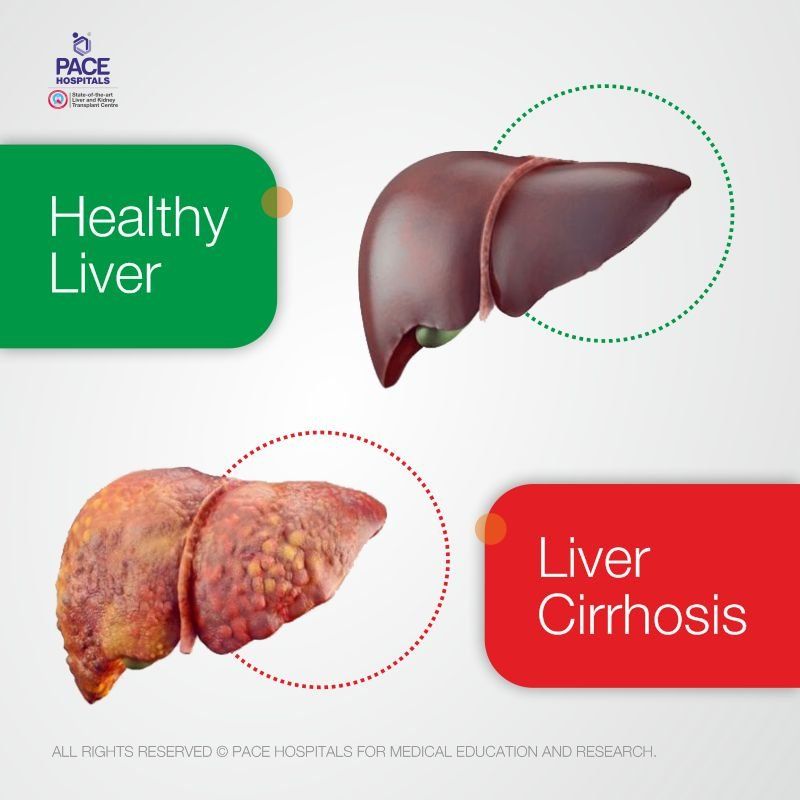 Indications for liver transplant | healthy liver and liver cirrhosis