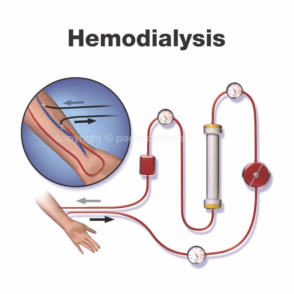 Hemodialysis - Best dialysis centers in Hyderabad India | Pace Hospitals