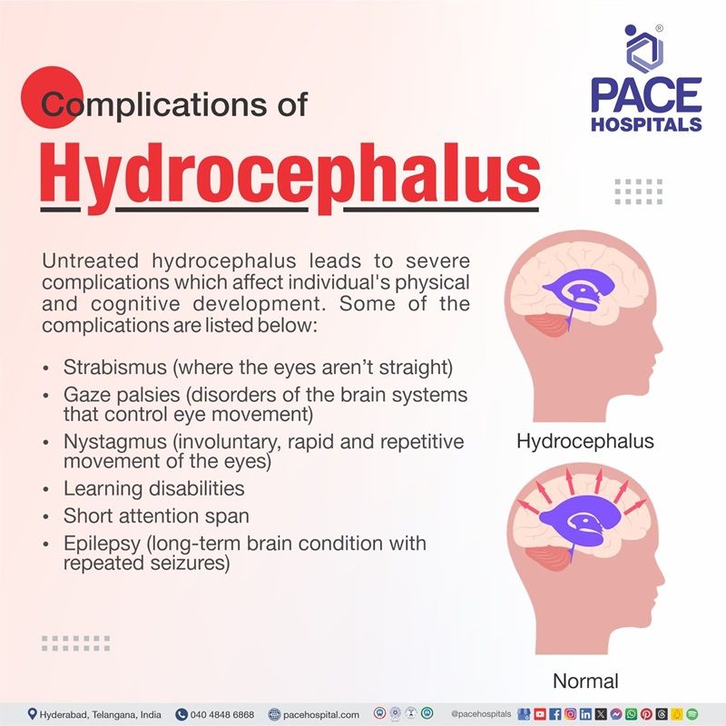 complications of hydrocephalus | complications of hydrocephalus in infants | hydrocephalus complications | Visual depicting the complications of hydrocephalus