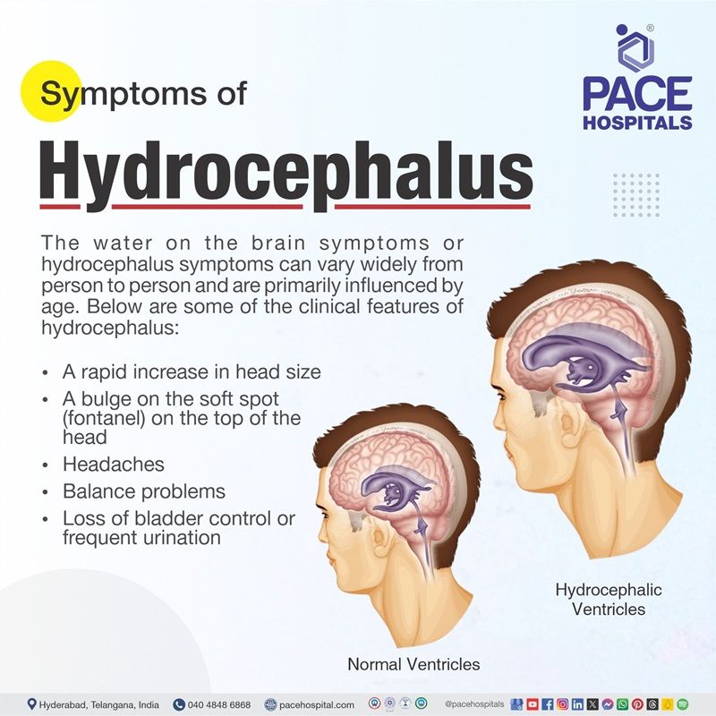 signs and symptoms of hydrocephalus | signs and symptoms of normal pressure hydrocephalus | normal pressure hydrocephalus symptoms | signs and symptoms of hydrocephalus in adults