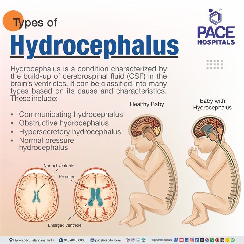 types of hydrocephalus | types of shunts for hydrocephalus | hydrocephalus types | Visual showing the types of hydrocephalus