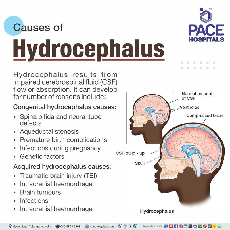 hydrocephalus causes | causes of communicating hydrocephalus | congenital hydrocephalus causes | normal pressure hydrocephalus causes | Visual revealing the causes of hydrocephalus