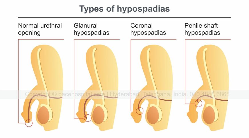 Types of Hypospadias