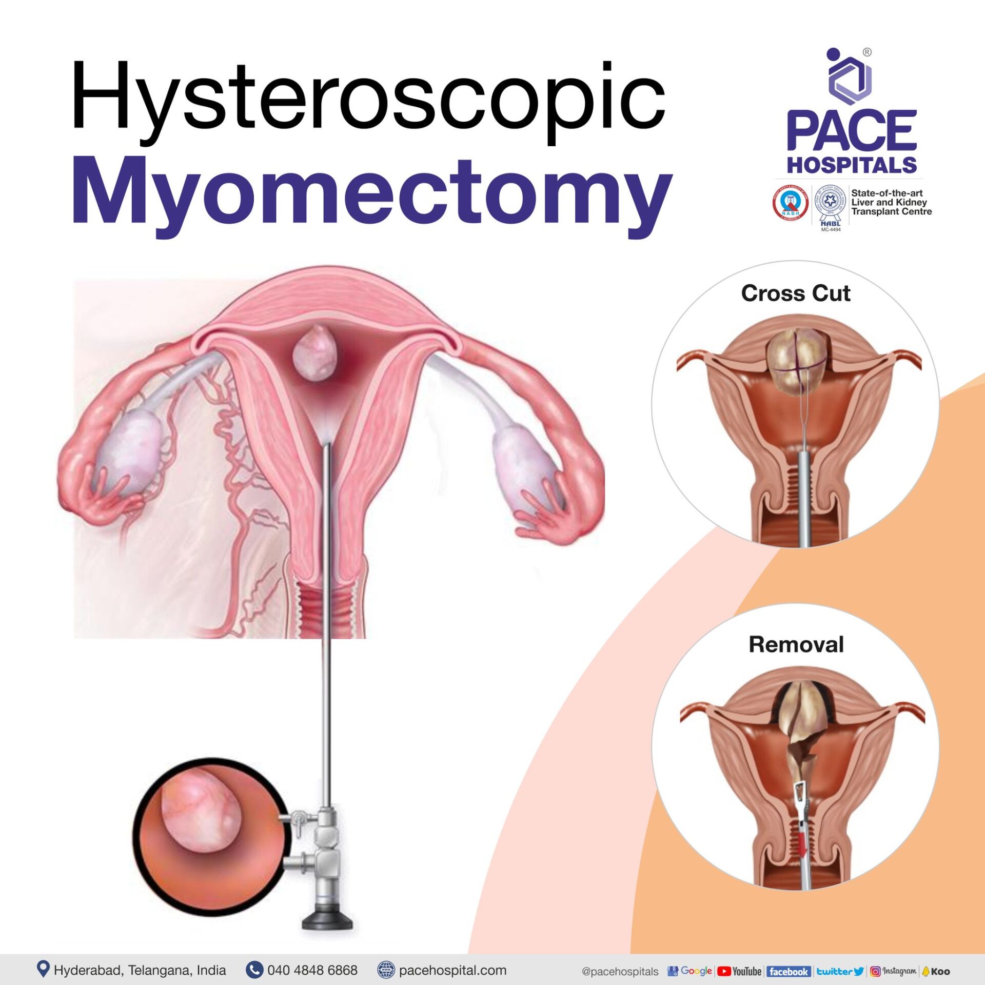 Hysteroscopic Myomectomy in Hyderabad | Hysteroscopic Myomectomy in India | Hysteroscopic Myomectomy Procedure