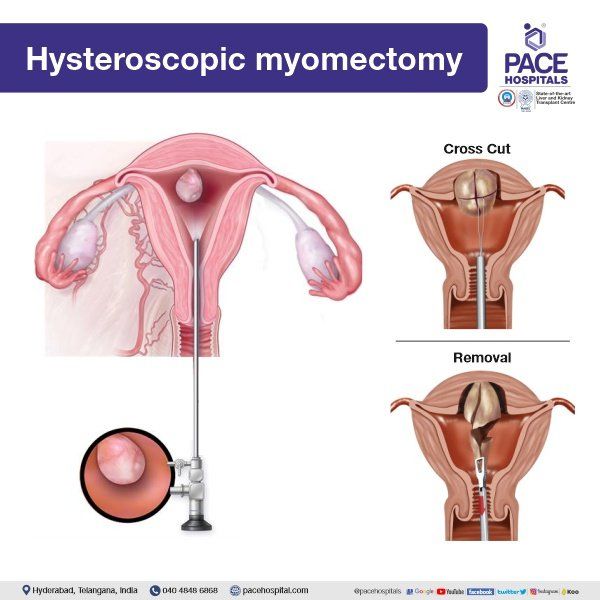 Hysteroscopic Myomectomy in Hyderabad | Uterine Fibroid surgery