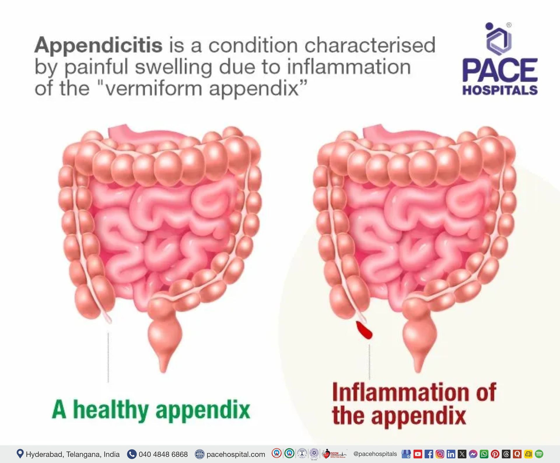 appendicitis meaning appendix meaning | appendicitis pain location | appendicitis meaning | appendicitis pain area