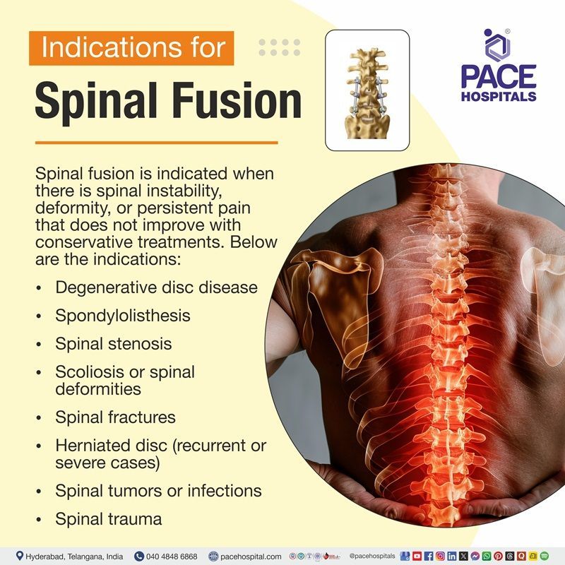 Signs for Spinal fusion surgery | Visual depicting the indications of Spinal fusion surgery
