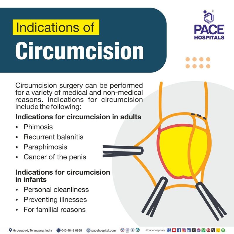 indications of circumcision | indications for circumcision | ZSR and laser circumcision near me | best hospitals for circumcision in Hyderabad India