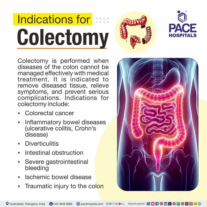 Colectomy Indications Visual depictijg the indications of Colectomy | Colectomy Indications