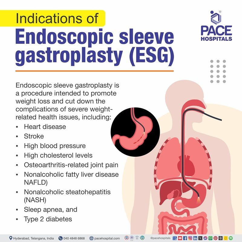 endoscopic sleeve gastroplasty indications | endoscopic sleeve gastroplasty results | endoscopic sleeve gastroplasty India