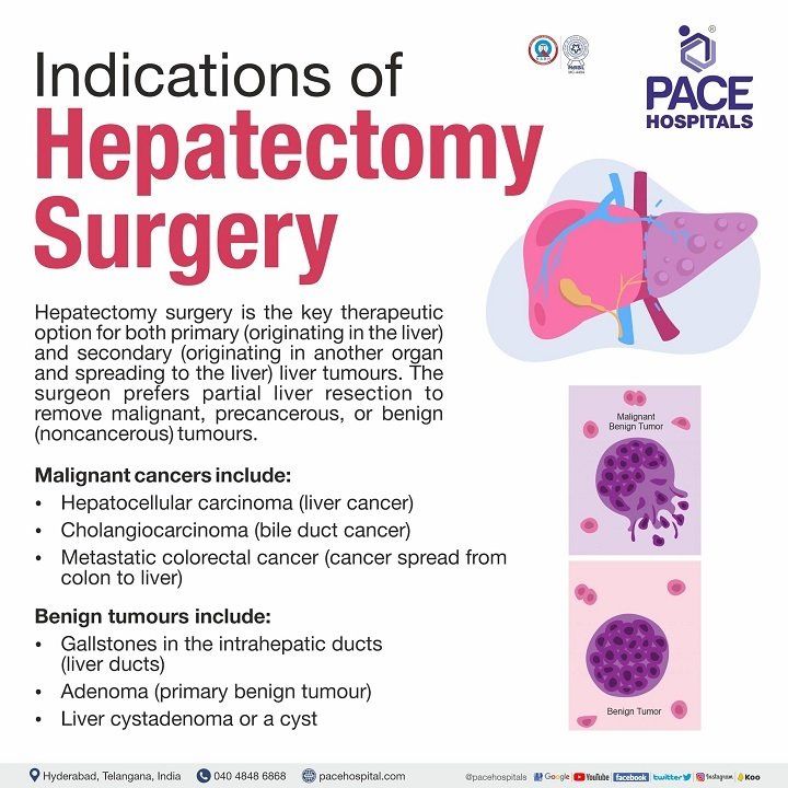 laparoscopic hepatectomy surgery in hyderabad, Telangana | hepatectomy indications | hepatectomy procedure