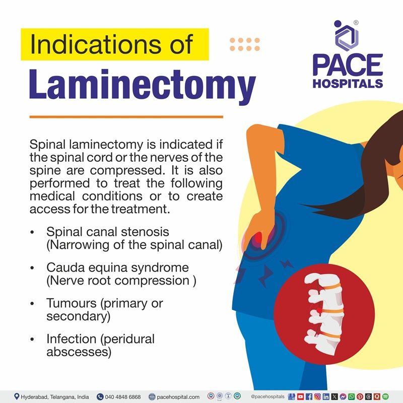 Laminectomy indications | image showing the list various Indications of laminectomy 