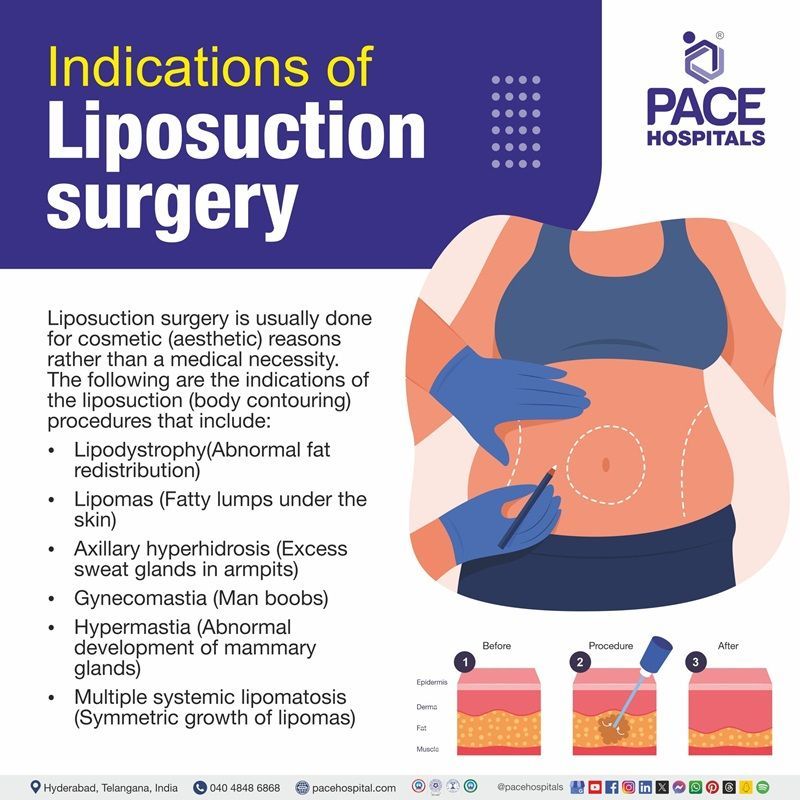 Indications of liposuction surgery | liposuction operation in Hyderabad | liposuction procedure in India | liposuction images | liposuction fat removal in Hyderabad