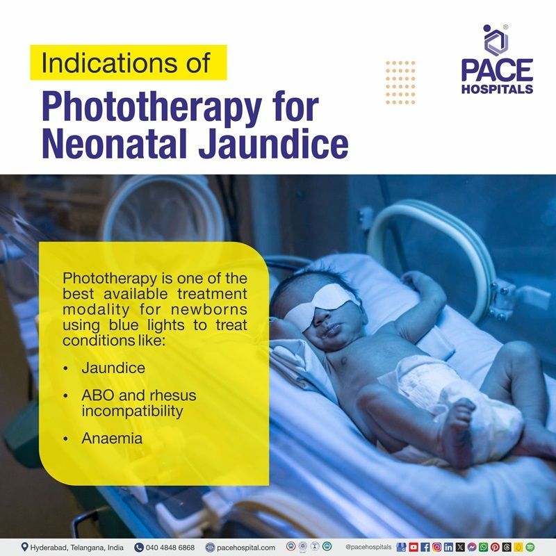 indication for phototherapy in newborn | indication for phototherapy in newborn | indications for phototherapy in neonates | indication of phototherapy in jaundice