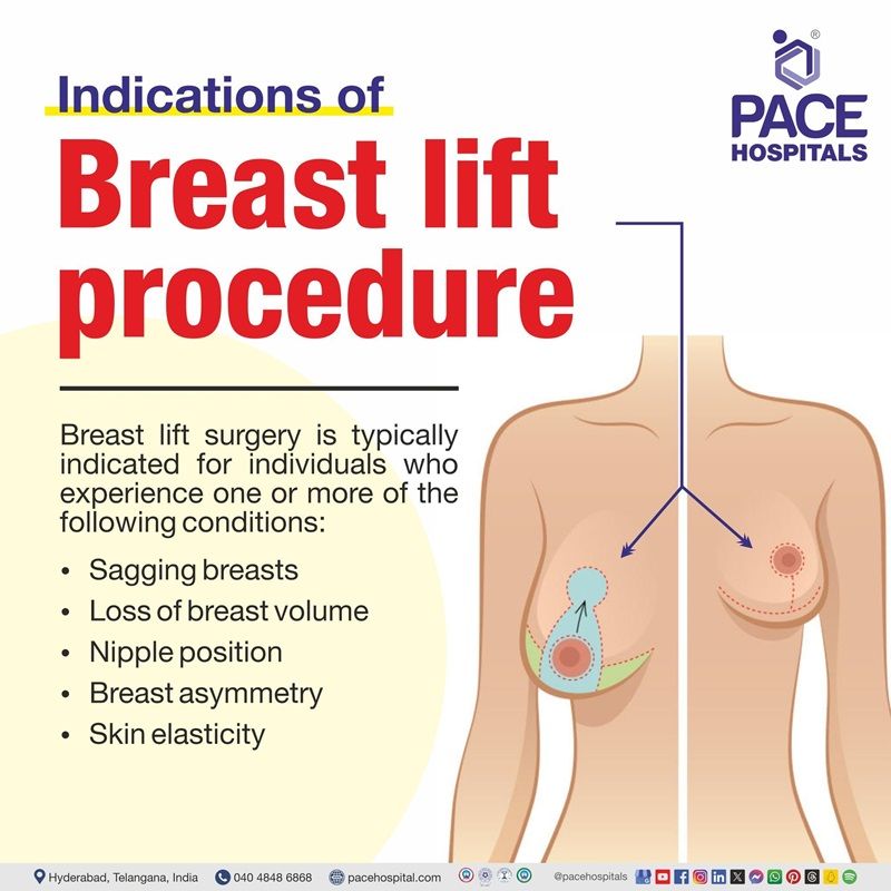 breast lift surgery indications | What are the indications of breast lift surgery | visual depicting the indications of breast lift treatment