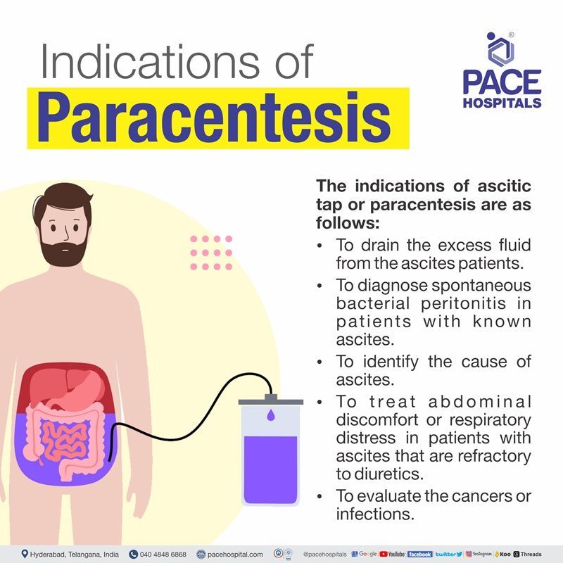 paracentesis indications | ascitic tapping indication | ascites tapping procedure indication