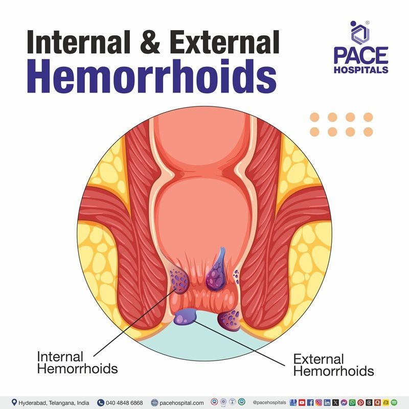 External hemorrhoids photo | hemorrhoids pictures | Image showing internal and external hemorrhoids
