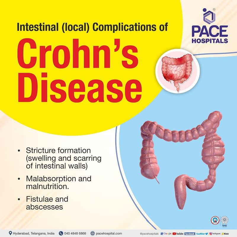 crohn's disease complications | Intestinal local complications of crohn's disease | crohn's disease of colon without complications | crohn's disease of large intestine without complications