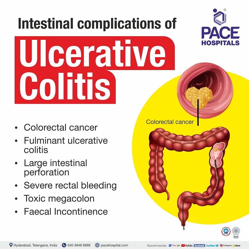 intestinal ulcerative colitis | intestinal manifestations of ulcerative colitis
