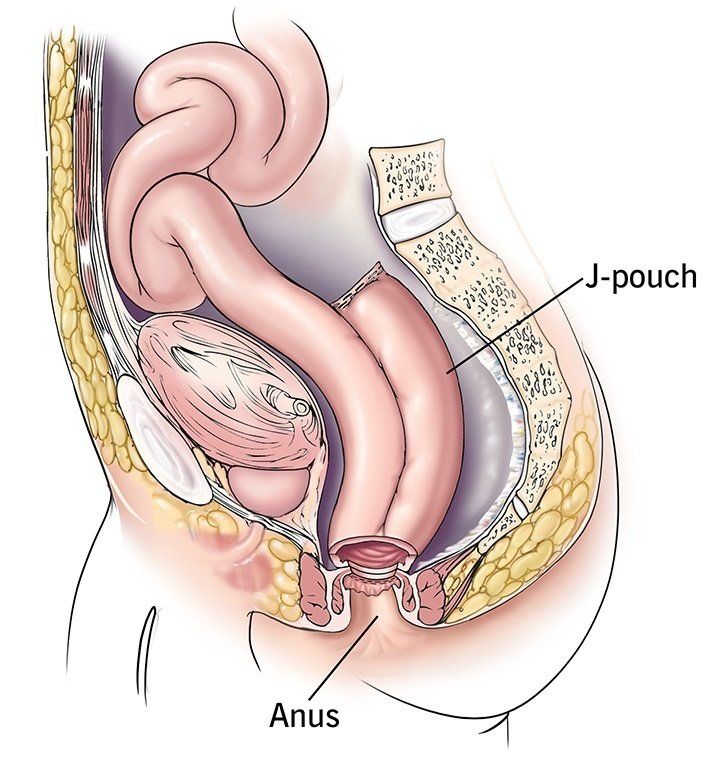 J-pouch surgery PACE Hospitals