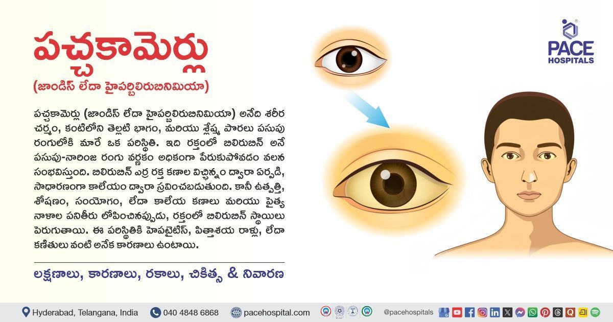 Jaundice - Symptoms, Causes, Types, Complications, Diagnosis, Treatment and Prevention in Telugu