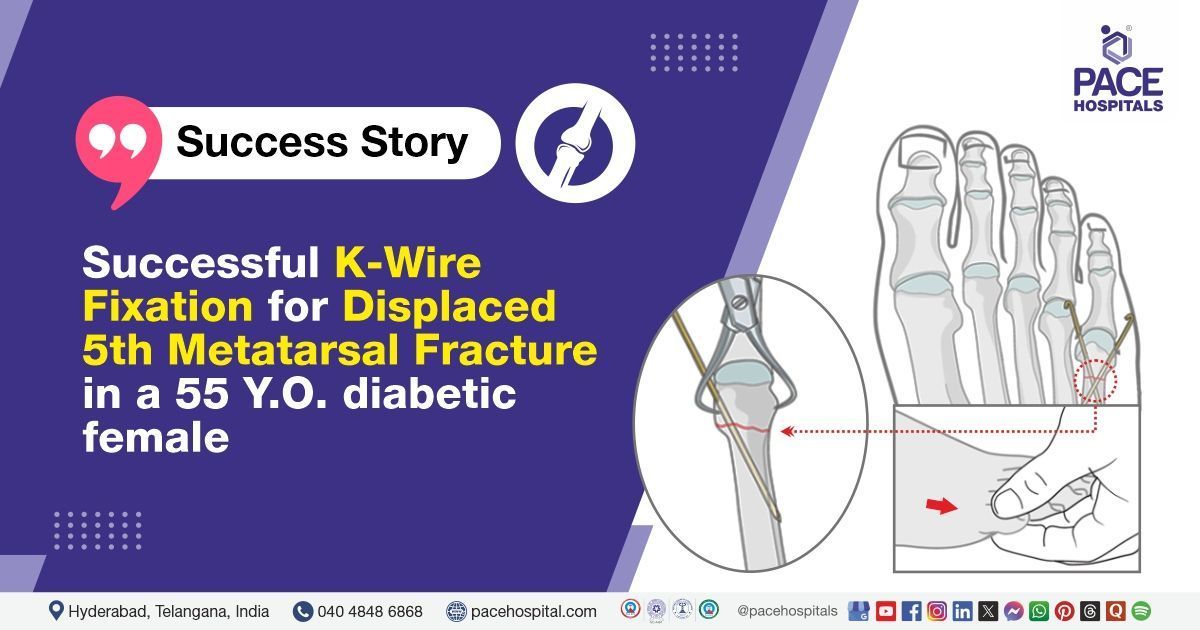 Case study of a 55 Y.O. woman who underwent metatarsal fracture treatment at PACE Hospitals