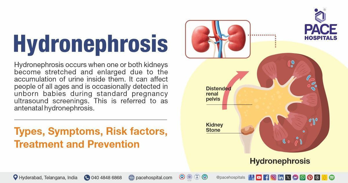 Kidney hydronephrosis | mild hydronephrosis treatment in India | moderate & gross hydronephrosis