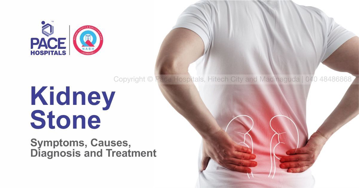 Kidney Stone: Causes, Symptoms, Diagnosis and Treatment