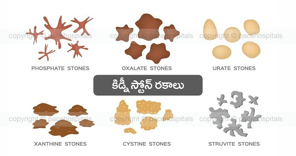 Kidney Stone Types in telugu
