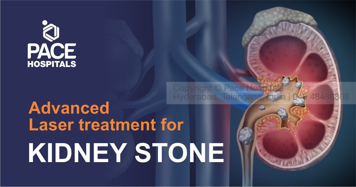 What are Kidney Stones and What are the options for kidney stones treatment?