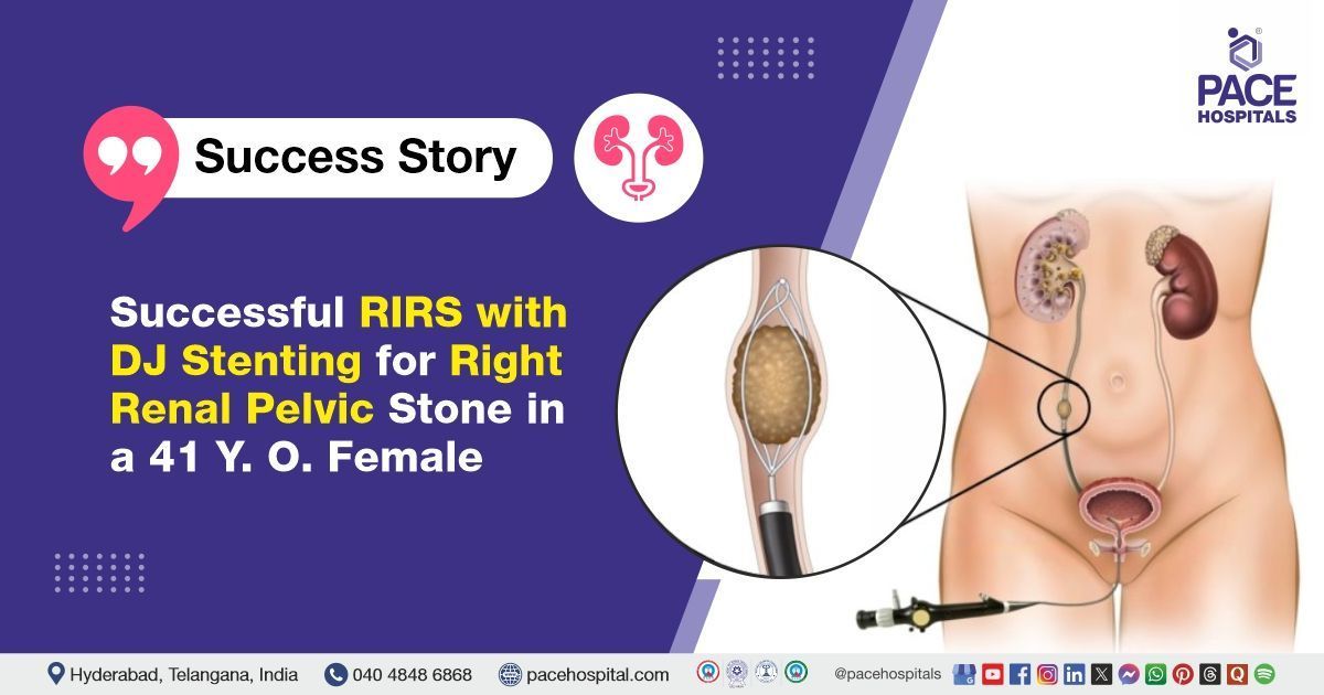 Case study of a 41-year-old female with a right renal pelvic stone treated at PACE Hospitals
