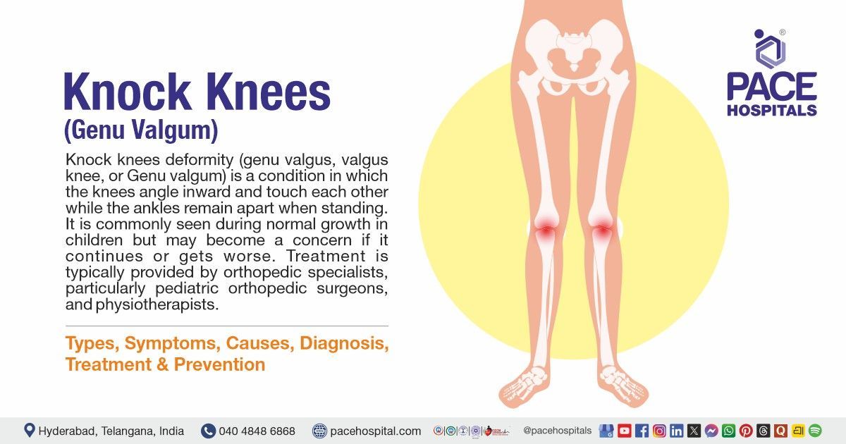 Knock Knees Symptoms, Causes, Types, Diagnosis and Treatment | Knock Knee | What is Genu Valgum