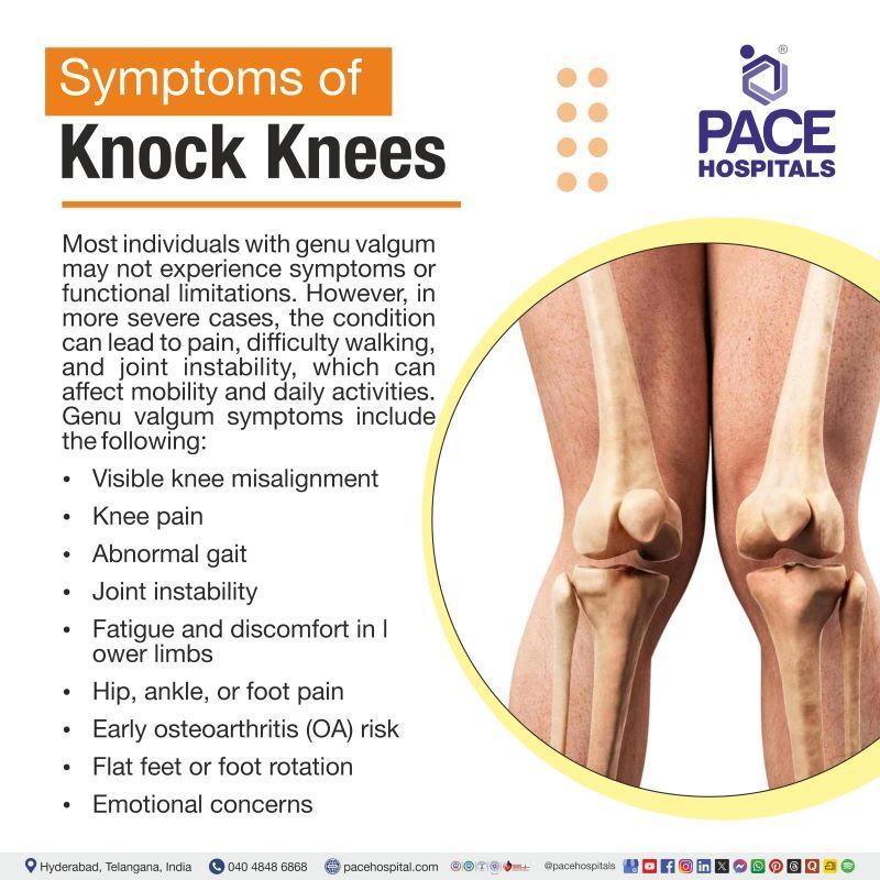 Knock Knees Symptoms | Genu valgum symptoms | Symptoms of Knock Knees