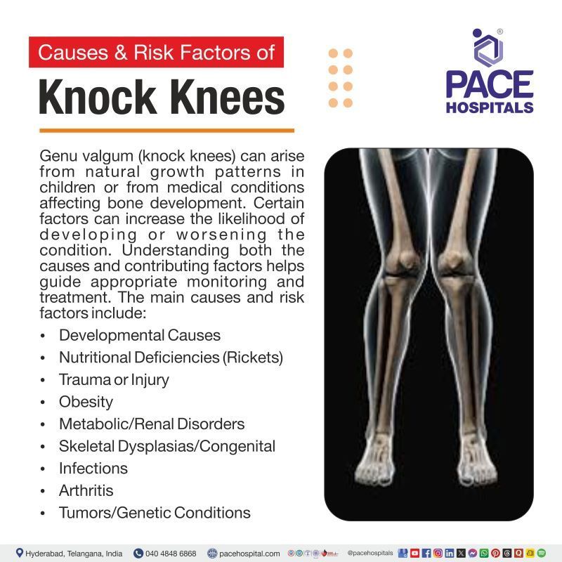 Knock knees causes | Genu valgum causes | What causes knock knees | What causes genu valgum