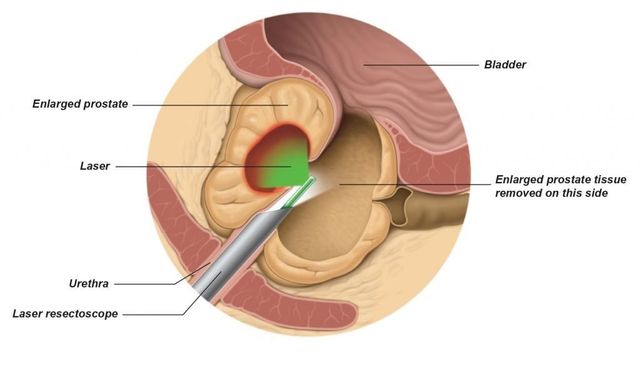 laser prostate surgery side effects)