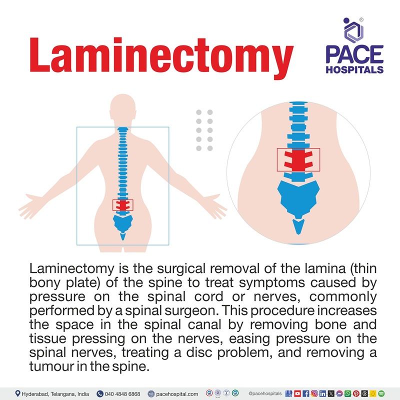 laminectomy meaning​ | laminectomy definition​ | Best hospital for Laminectomy Procedure in Hyderabad, Telangana, India