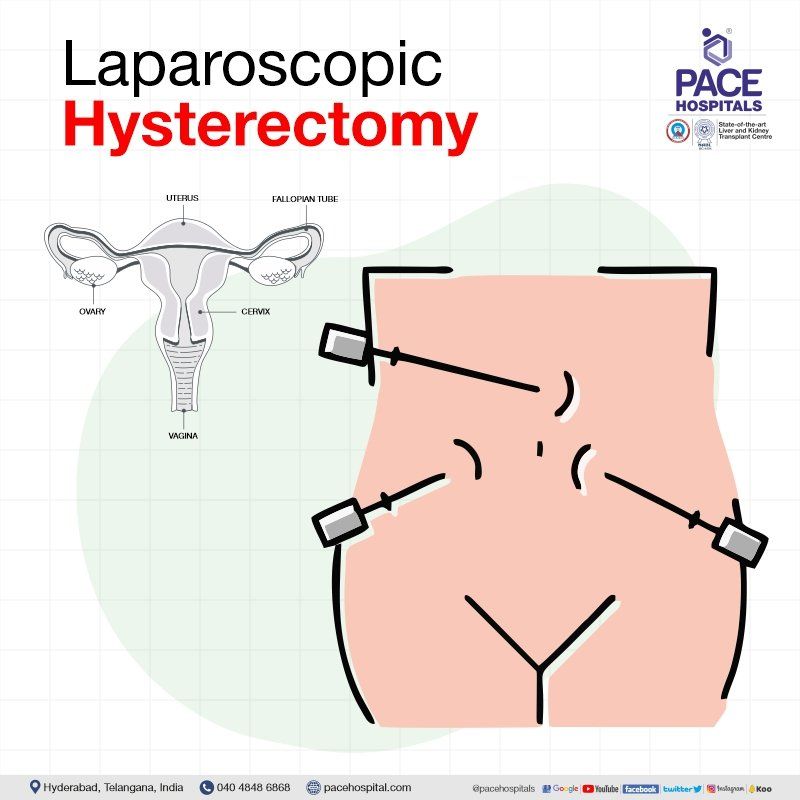 Laparoscopic hysterectomy in Hyderabad | Laparoscopic hysterectomy in India | Laparoscopic hysterectomy procedure | Total laparoscopic hysterectomy | TLH surgery
