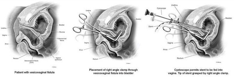 Vesicovaginal Fistula Repair