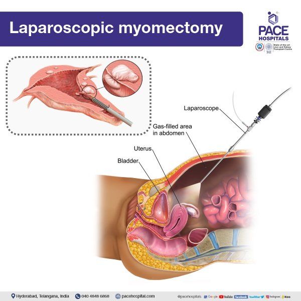 Laparoscopic Myomectomy in Hyderabad | Laparoscopic Myomectomy | Laparoscopic fibroid removal