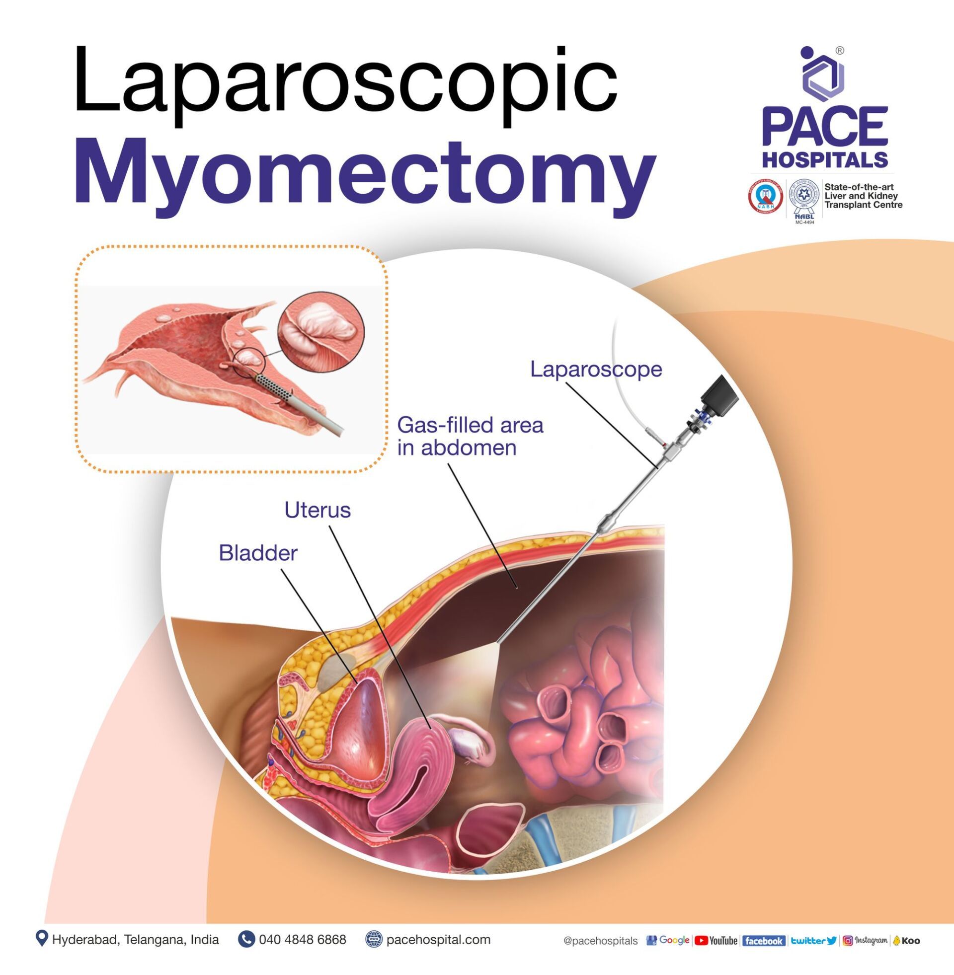 Laparoscopic Myomectomy in Hyderabad | Laparoscopic Myomectomy in India | Laparoscopic Myomectomy surgery