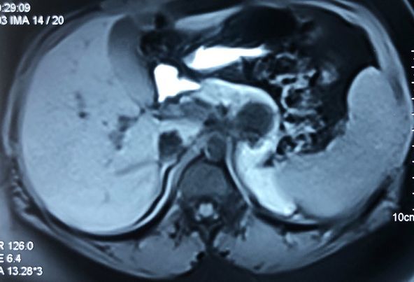 Laparoscopic spleen preserving distal pancreatectomy (WARSHAW TECHNIQUE)