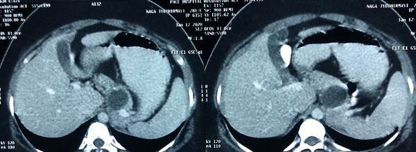 Laparoscopic spleen preserving distal pancreatectomy (WARSHAW TECHNIQUE) 35 yr old morbidly obese patient