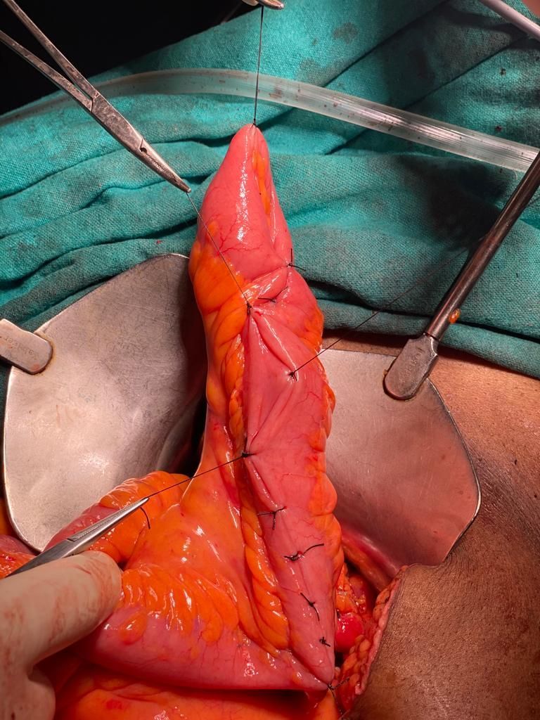 Laparoscopic total proctocolectomy and J-pouch surgery at PACE Hospitals