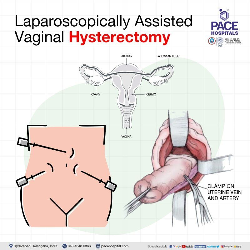 Laparoscopic assisted vaginal hysterectomy in Hyderabad | Laparoscopic assisted vaginal hysterectomy in India | LAVH procedure | LAVH Surgery | Laparoscopic vaginal hysterectomy